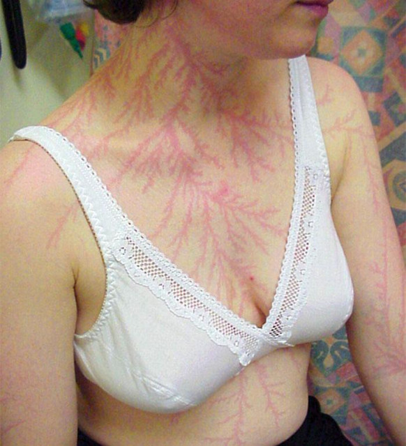 Red raised fern-like marks on the upper body of a female lightning strike survivor.