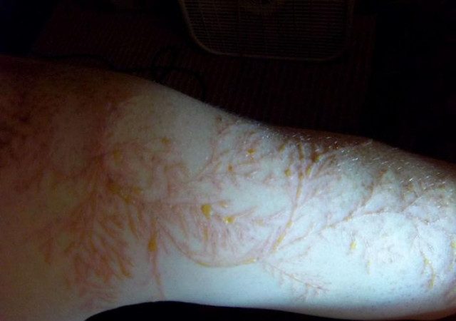 Red raised fern-like marks on the arm of a lightning strike survivor.