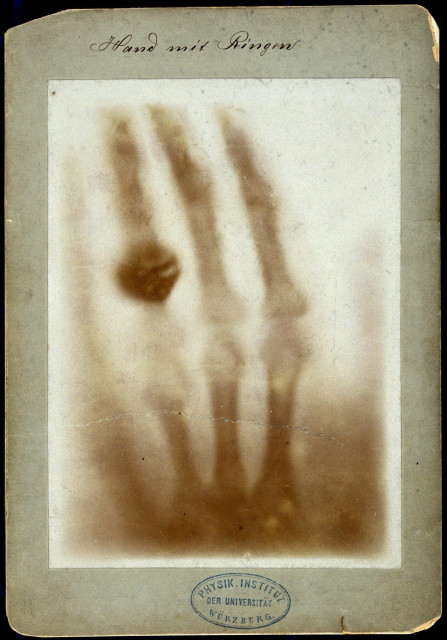 One of the first X-ray photographs, an exposure of the left hand of Rontgen's wife. You can see her four finger, the dark mass of a ring on her ring finger, and the faint shadow of the soft tissue.