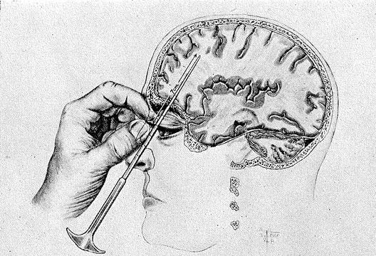 Illustration of a lobotomy.