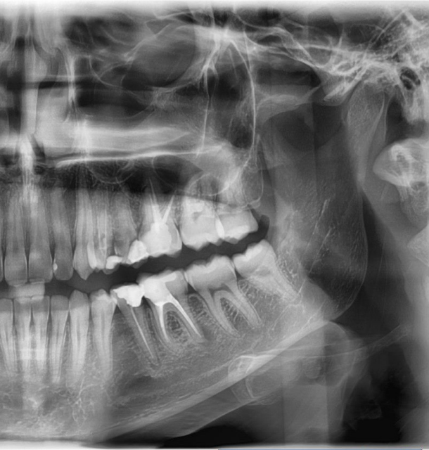 A panoramic X-ray I took during my procedure. 