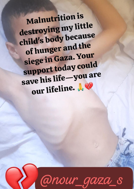 Every sign of malnutrition is visible on my little child—even his rib cage is clearly showing.